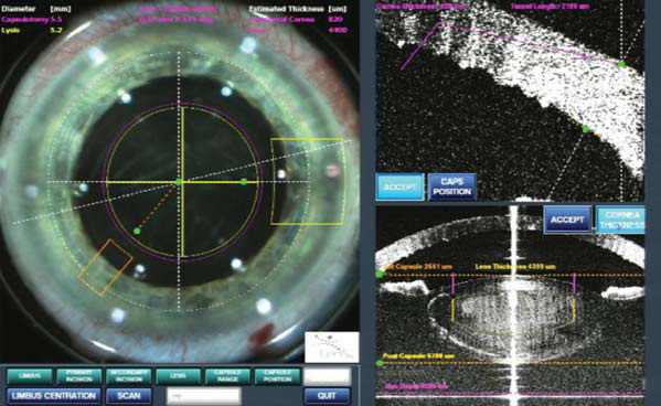 laser cataract surgery colorado springs
